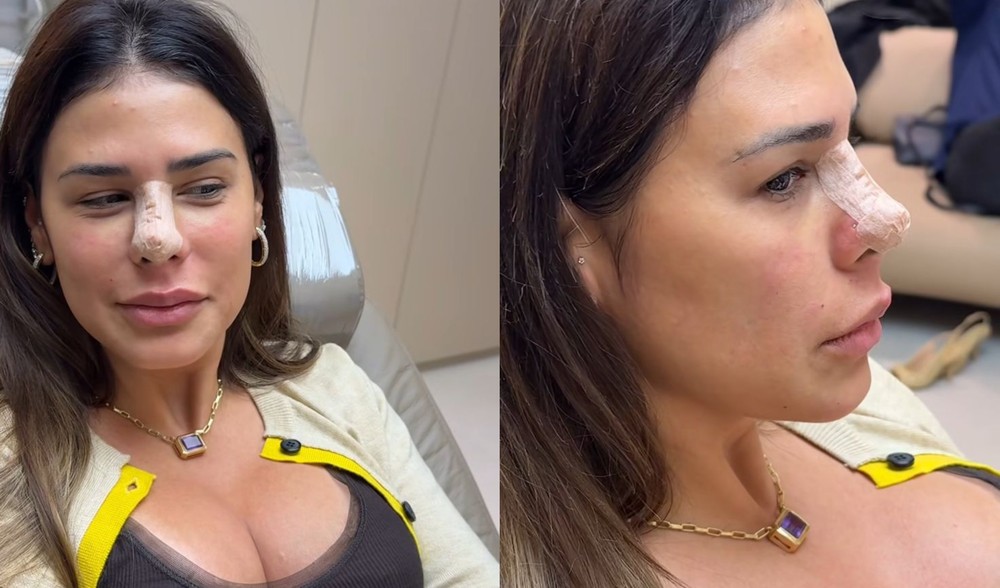 Aos 42 anos, Simone Mendes surge com curativo no nariz após procedimento estético e detalha recuperação