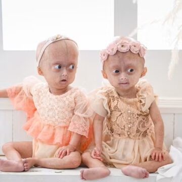 Morre aos 5 anos Elis, uma das gêmeas diagnosticadas com rara síndrome de envelhecimento precoce