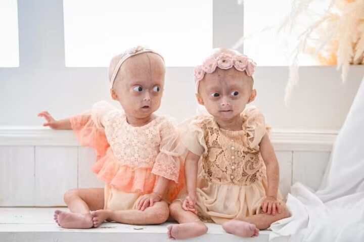 Morre aos 5 anos Elis, uma das gêmeas diagnosticadas com rara síndrome de envelhecimento precoce