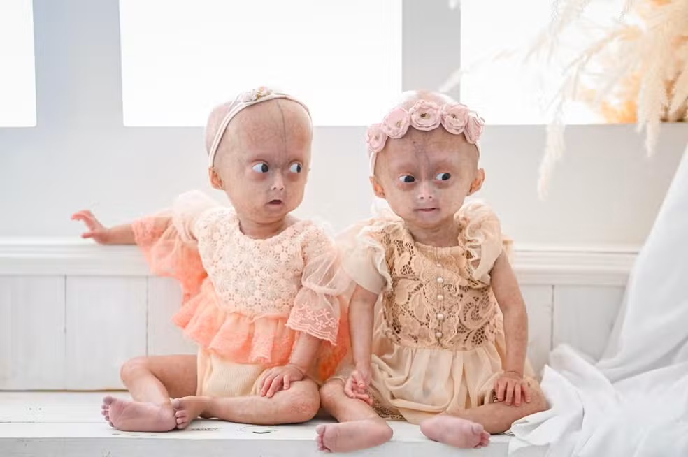 Morre aos 5 anos Elis, uma das gêmeas diagnosticadas com rara síndrome de envelhecimento precoce