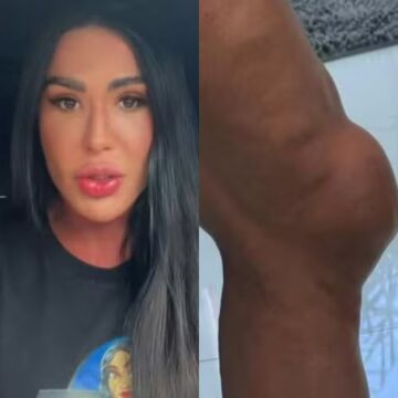 Gracyanne Barbosa comemora recuperação do joelho após cirurgia: ‘Segunda semana sem inchar’