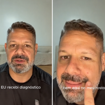 Danniel Vieira recebe diagnóstico de câncer de pele e faz vídeo de alerta: ‘Não seja pego de surpresa’