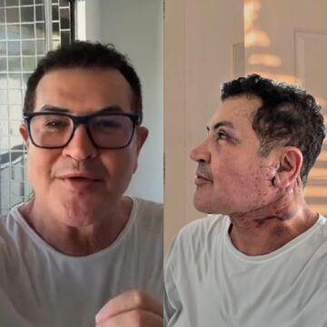 Aos 71 anos, Beto Barbosa passa por cirurgia plástica no rosto e revela motivo