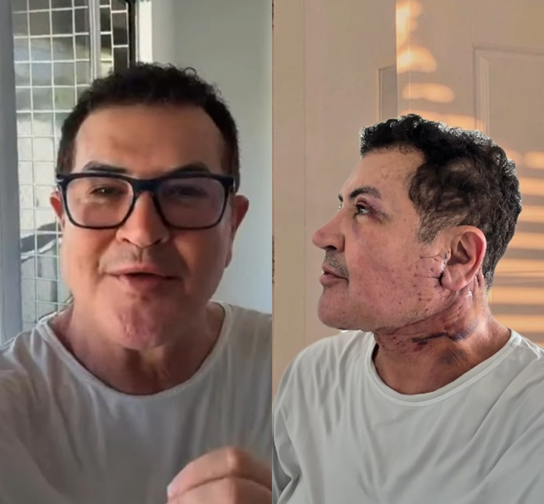 Aos 71 anos, Beto Barbosa passa por cirurgia plástica no rosto e revela motivo